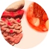 Ulcerative Colitis Treatment Specialist Doctor in NYC