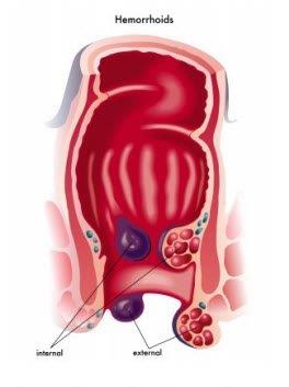 Hemorrhoids Doctor NYC | Manhattan Gastroenterology esophagus cancer diagram 