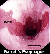 Barrett’s Esophagus GI Doctor NYC