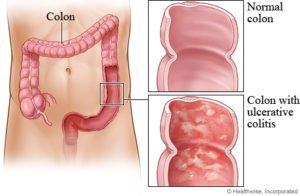 Ulcerative Colitis
