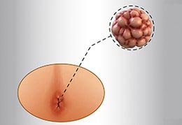 Anal Warts