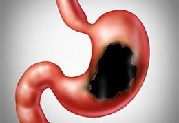 Peptic Ulcers