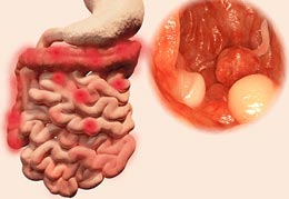 Ulcerative Colitis