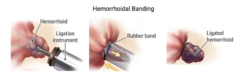 Hemorrhoid Banding Treatment Manhattan