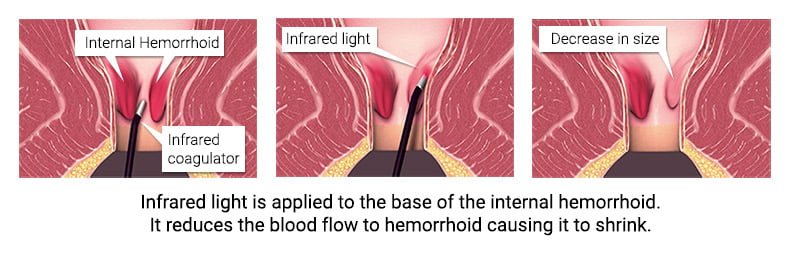 Infrared Coagulation IRC Hemorrhoids Treatment NYC