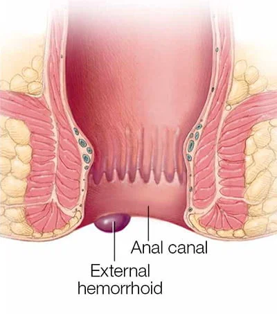 External Hemorrhoids Treatment in NYC