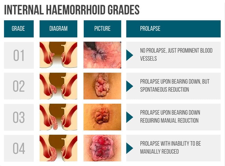 Hemorrhoid Treatment Specialist Nyc New York City Hemorrhoid Doctor