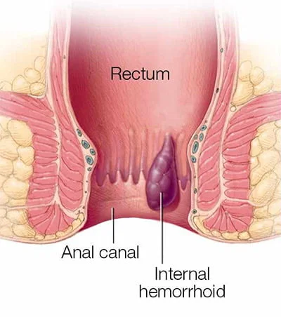 Internal Hemorrhoids Treatment in NYC