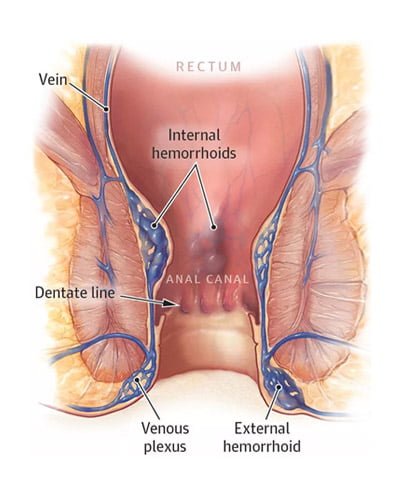 Our board-certified gastroenterologists are experts in non-surgical hemorrhoid treatments offering safe and effective same-day removal in Midtown & Upper East Side NYC.