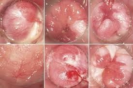 anal pap smear specialist
