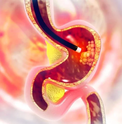 upper ENDOSCOPY