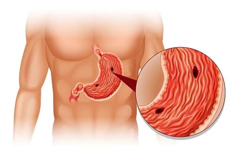 Peptic ulcers