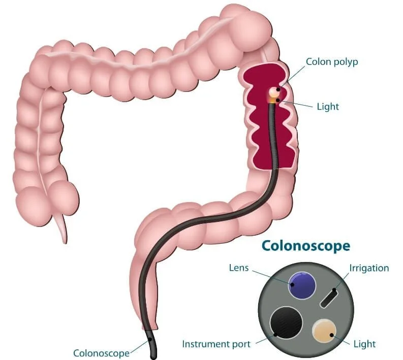 Colonoscopy Procedure