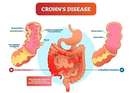 crohns disease