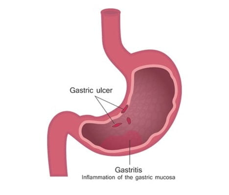 stomach diseases