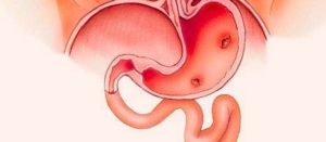 pylori ulcers