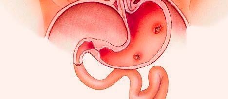 Stomach Ulcer - H.Pylori