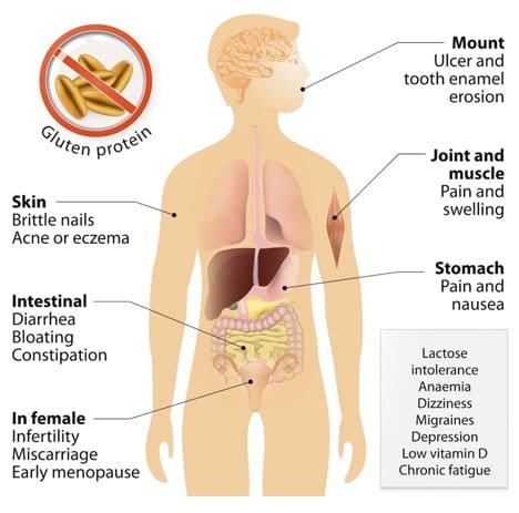 SYMPTOMS OF CELIAC DISEASE