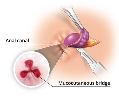 Anal Surgery for Hemorrhoids: Background, Indications, Contraindications