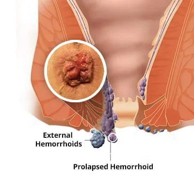 Prolapsed Hemorrhoid Treatment in NYC