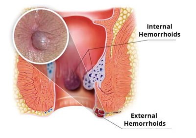 Thrombosed Hemorrhoids Treatment in NYC