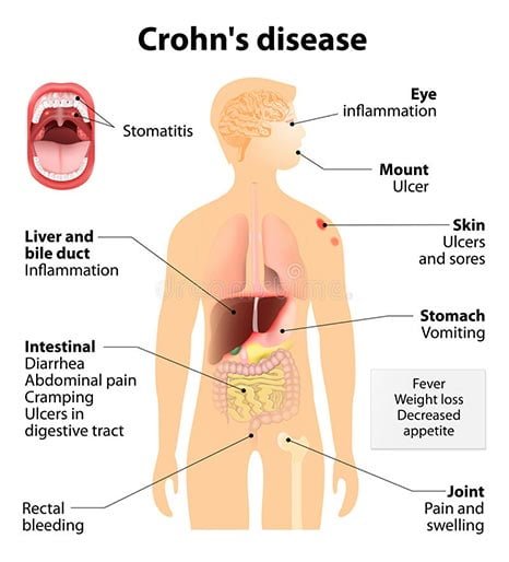 Inflammatory Bowel Disease IBD Symptoms