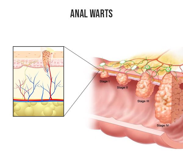 Treatment Anal Warts
