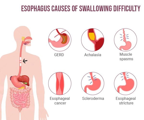 Swallowing Issues Gastroenterologists in NYC | Dysphagia Treatment