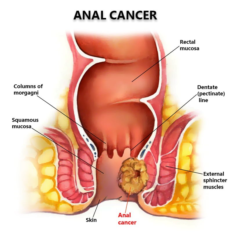 Anatomy of Anal Cancer