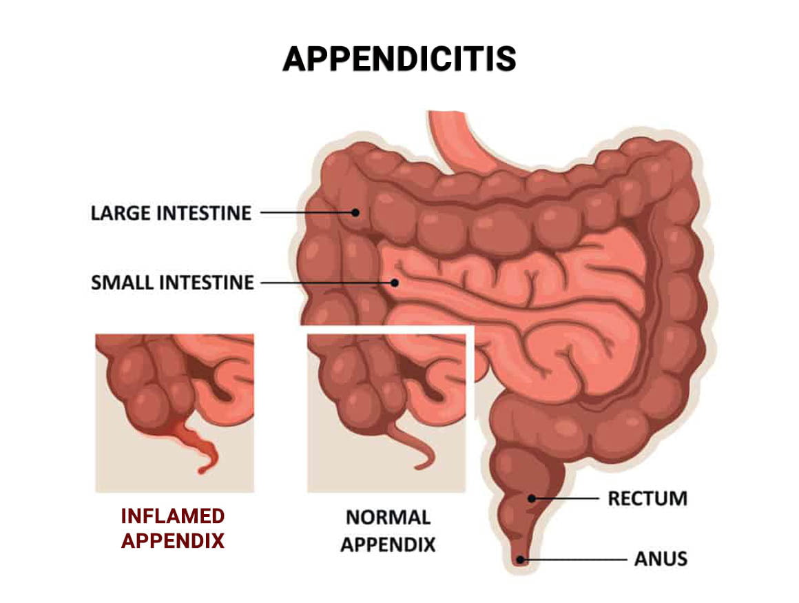 Appendicitis NYC