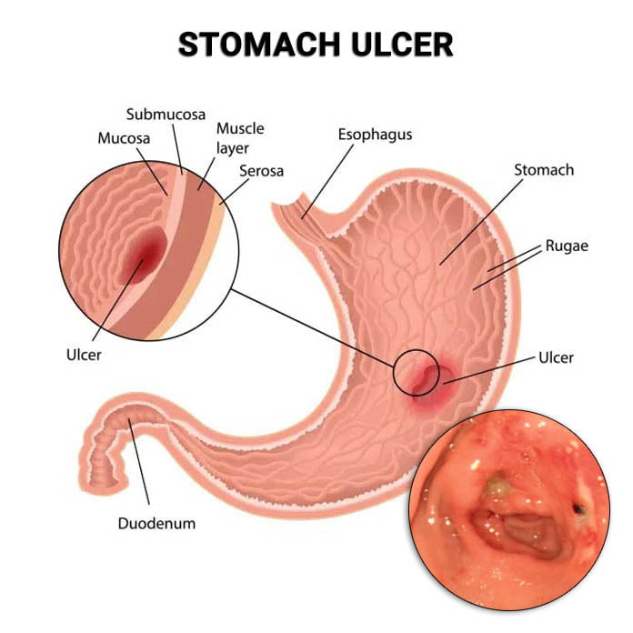 Stomach Ulcer