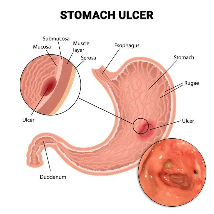 Stomach Ulcer