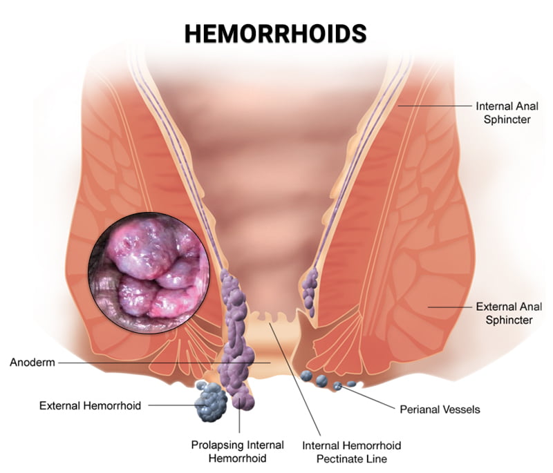 Hemorrhoids NYC