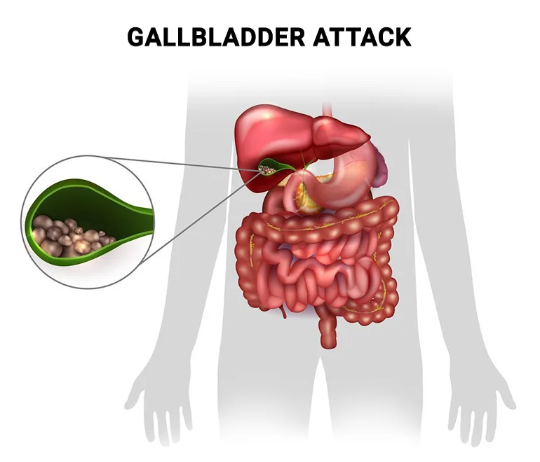 Gallbladder Attack