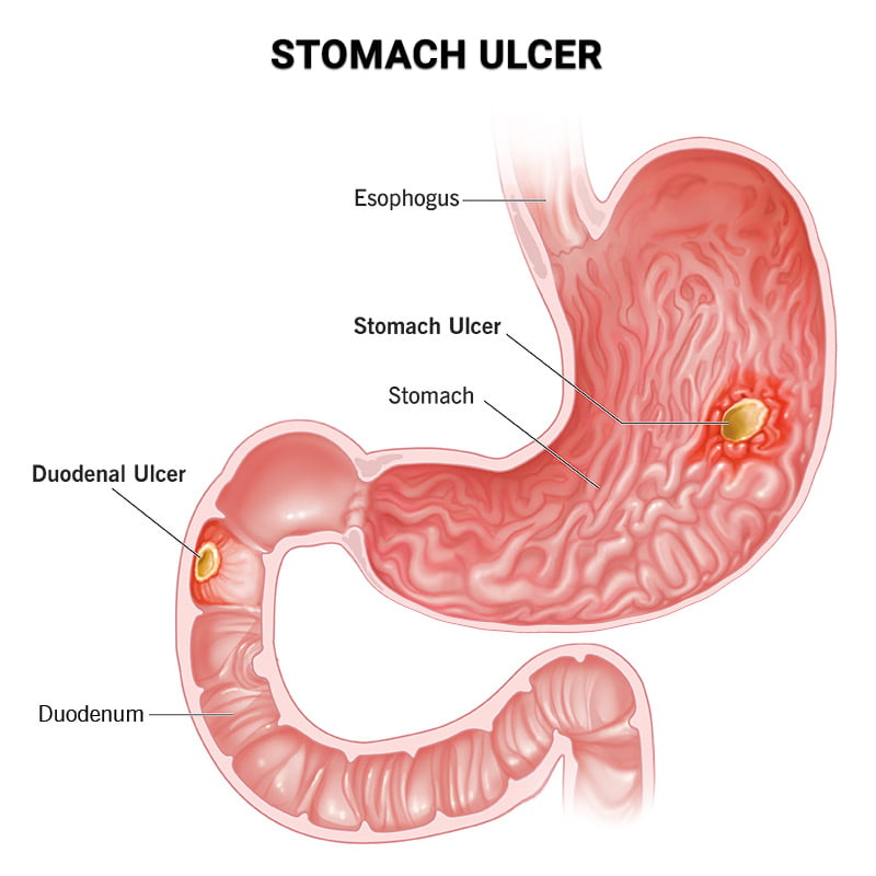 Stomach Ulcer NYC