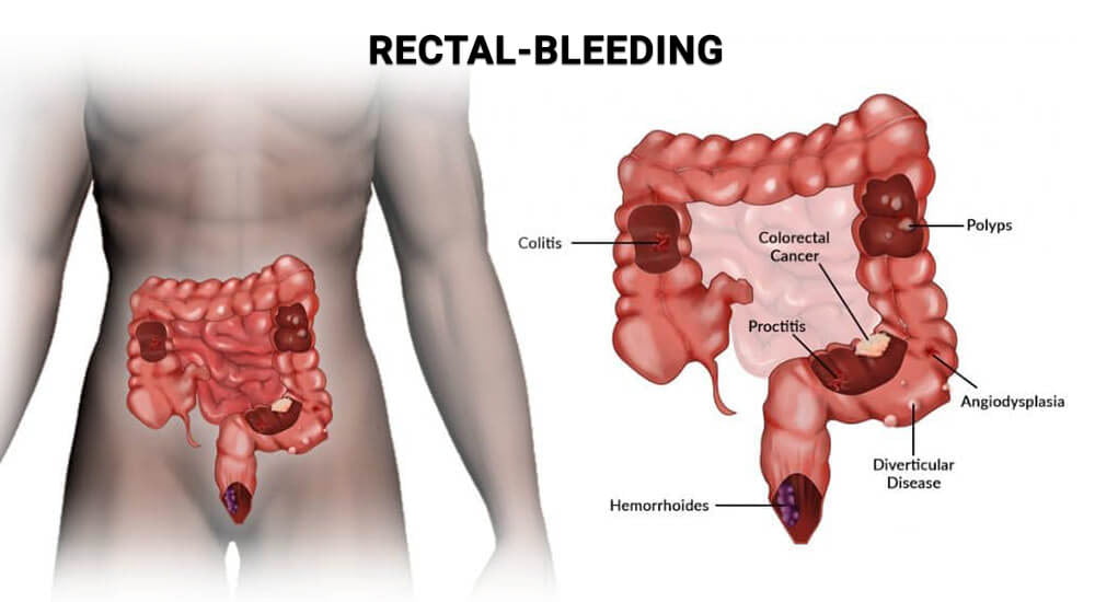 Why I Have Blood In My Stool? - Manhattan Gastroenterology