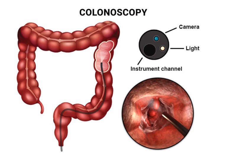 1 Prep Instructions for Your Colonoscopy Manhattan Gastroenterology