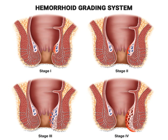 Hemorrhoid Grading System