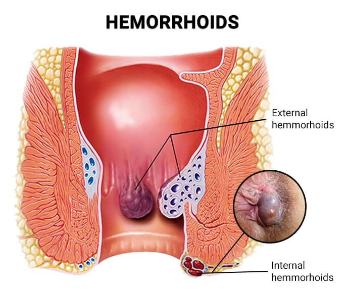 Hemorrhoids