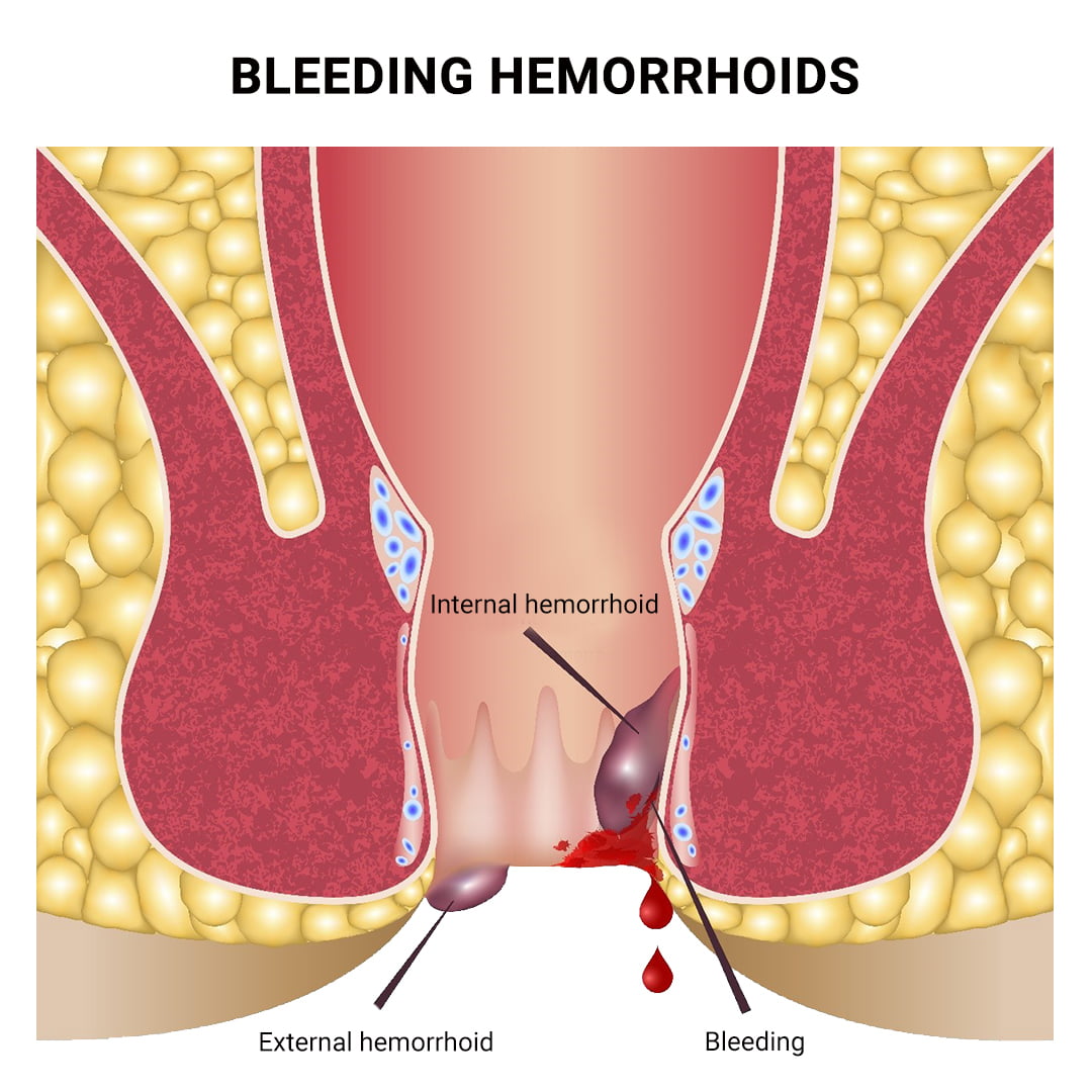 Bleeding Hemorrhoids
