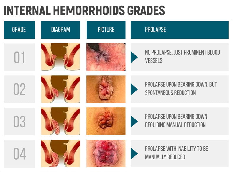 Hemorrhoids Grades