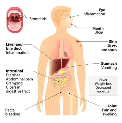 crohns disease symptoms