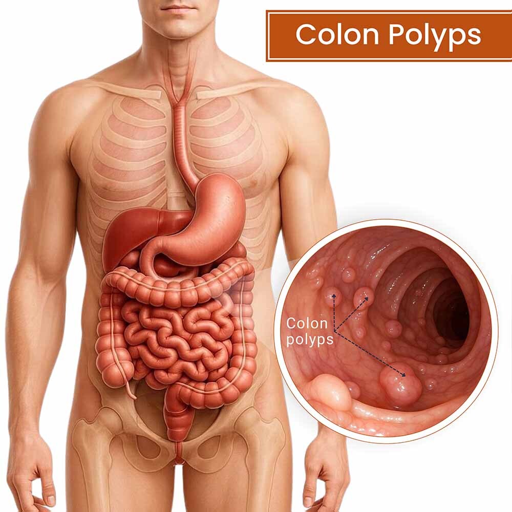 Colon Polyps Anatomy Manhattan Gastroenterology