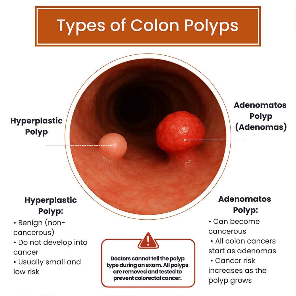 How Long Does It Take For A Rectal Polyp To Become Cancerous